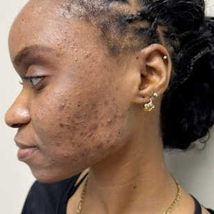 Client skin at week 1