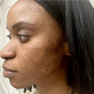 Client skin at week 3