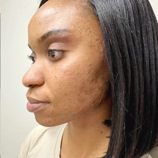 Client skin at week 5