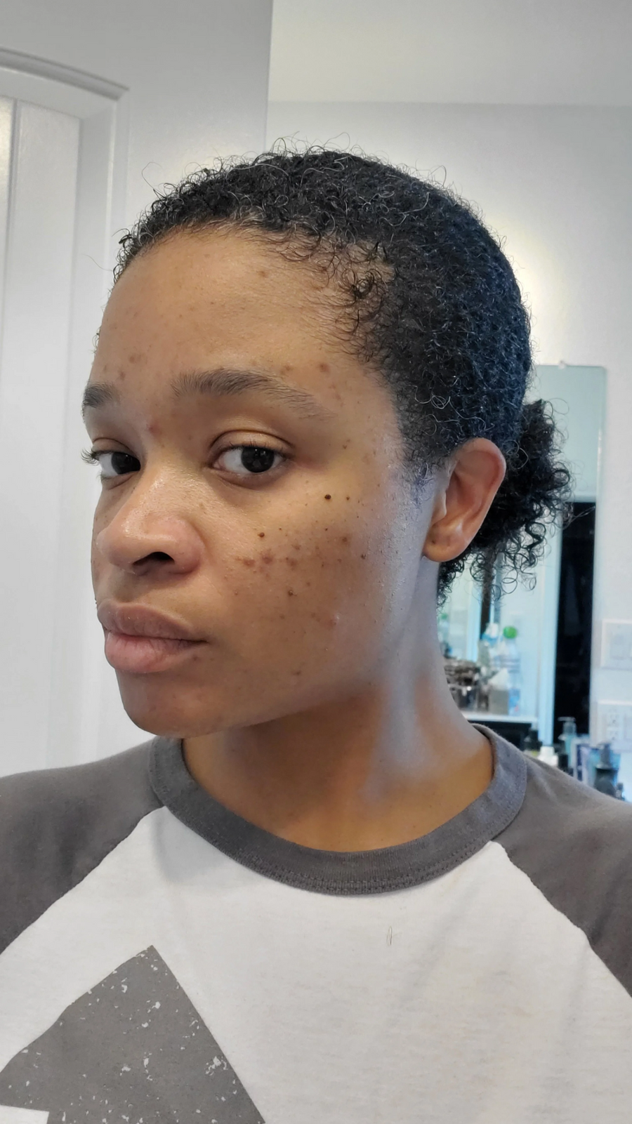 Keisha’s skin while using the Arbutin cream